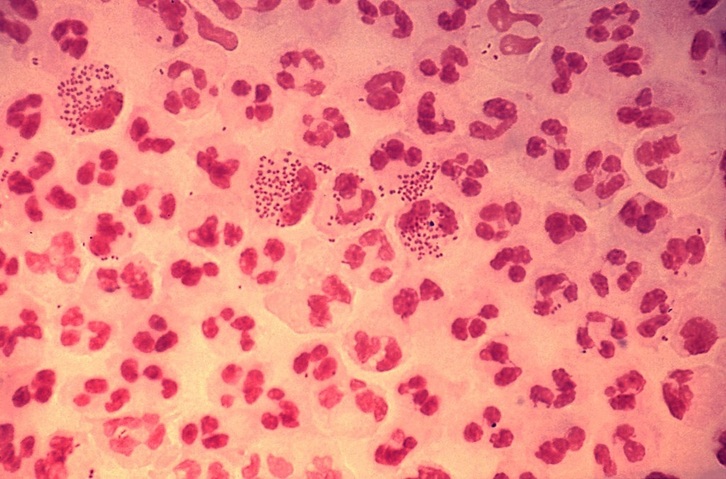 Microfotografía en un caso agudo de uretritis gonocócica, causada por la bacteria ‘Neisseria gonorrhoeae’.