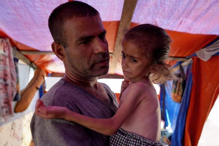 Hana Abdelrahaman al-Rai, niña palestina de cuatro años con señales de malnutrición. 
