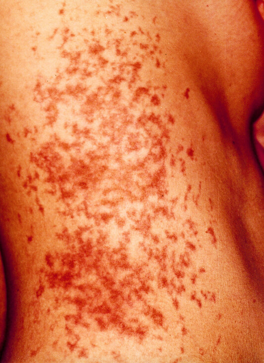 Marcas que dejaron los electrodos en el cuerpo de Iratxe Sorzabal.